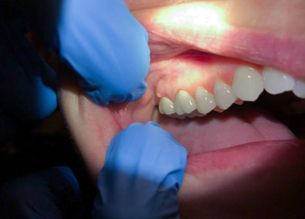 Best Emergency Gum Treatment in Brazoria, TX